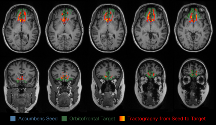 single_subject_tractography_figure